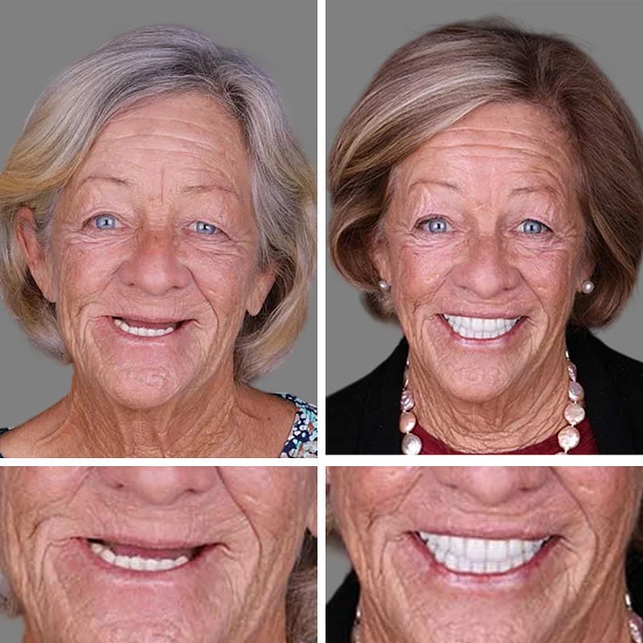 Medical Full Denture with Strong Suctiond🦷Obtain American Dental Association (ADA) Certification - Image 11
