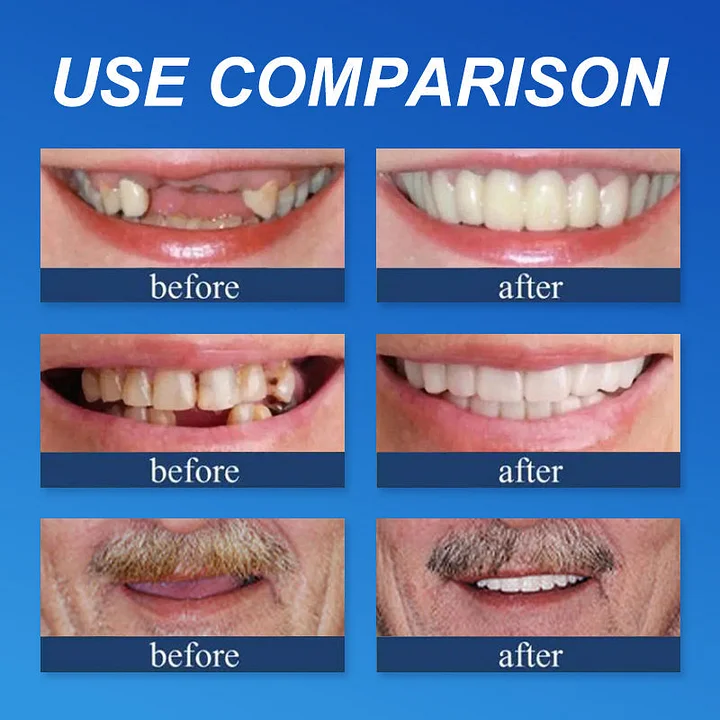 Medical Full Denture with Strong Suctiond🦷Obtain American Dental Association (ADA) Certification - Image 7