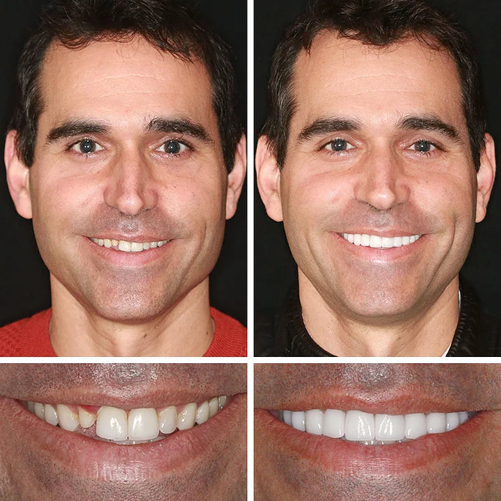 Medical Full Denture with Strong Suctiond🦷Obtain American Dental Association (ADA) Certification - Image 9