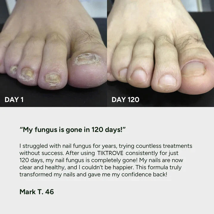 Nail Fungus Treatment Gel - Image 4