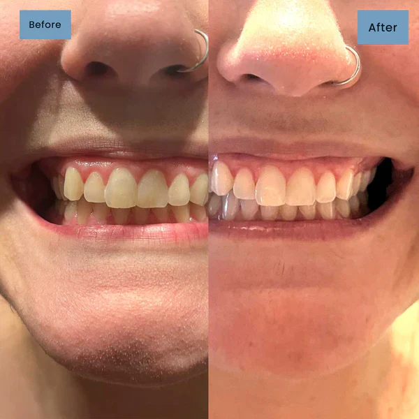 🦷 Niacinamide Whitening Toothpaste - For Healthier, Whiter Teeth! - Image 4
